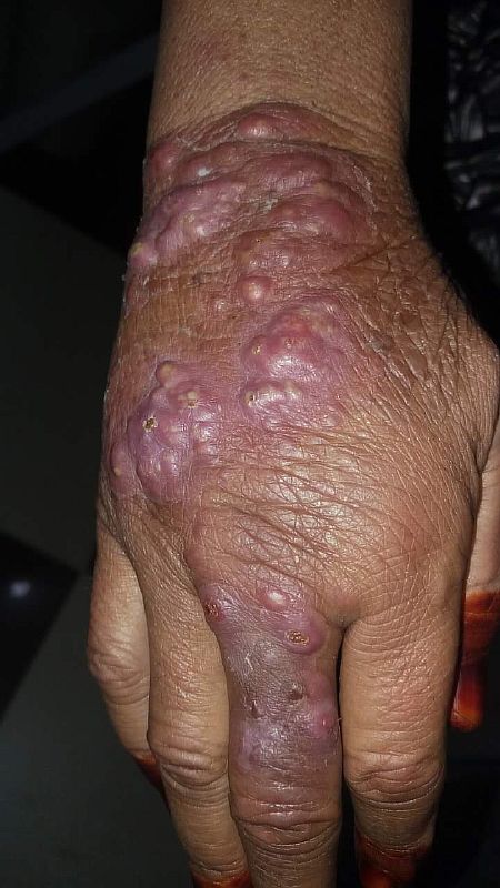 leshmaniasis-new-photo-to-help-in-diagnosis.jpg leshmaniasis-new-photo-to-help-in-diagnosis.jpg