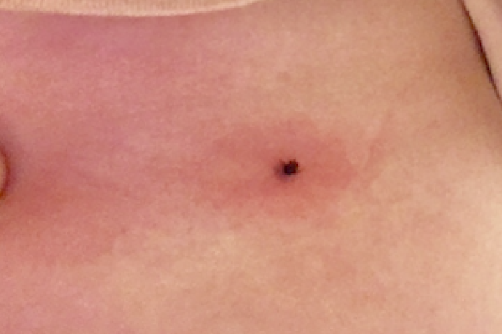 tick-bite-2.png