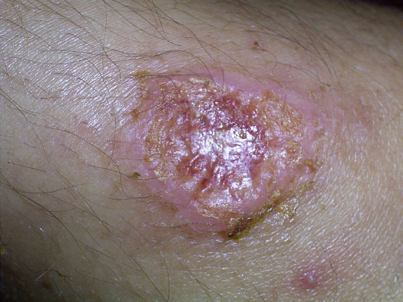 cutaneous-leishmaniasis-hr.jpg cutaneous-leishmaniasis-hr.jpg