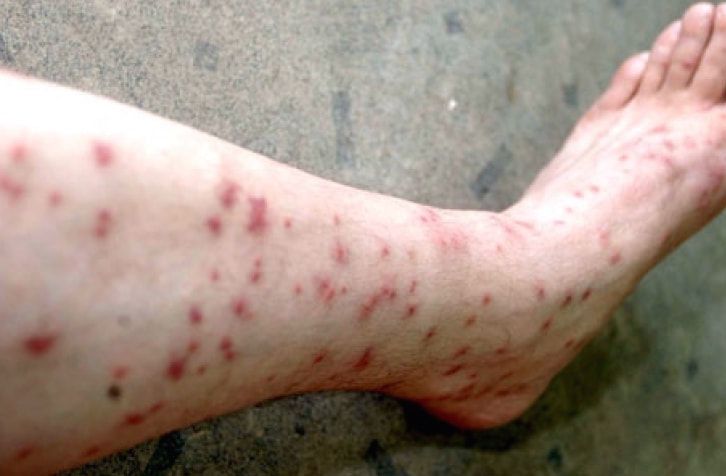 flea-bites-on-humans.jpg