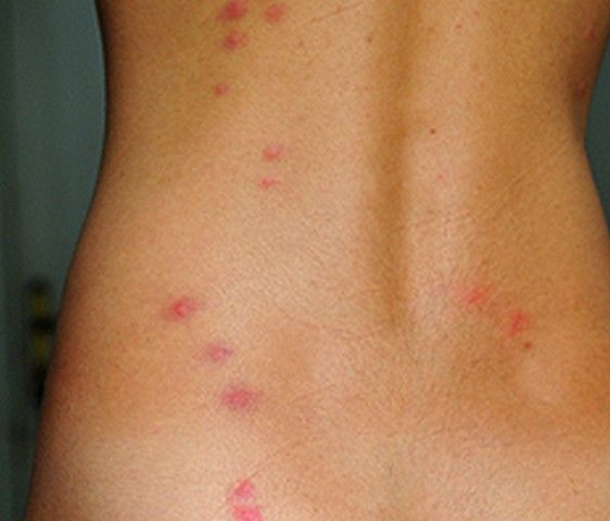 bed-bug-bites-back.jpg