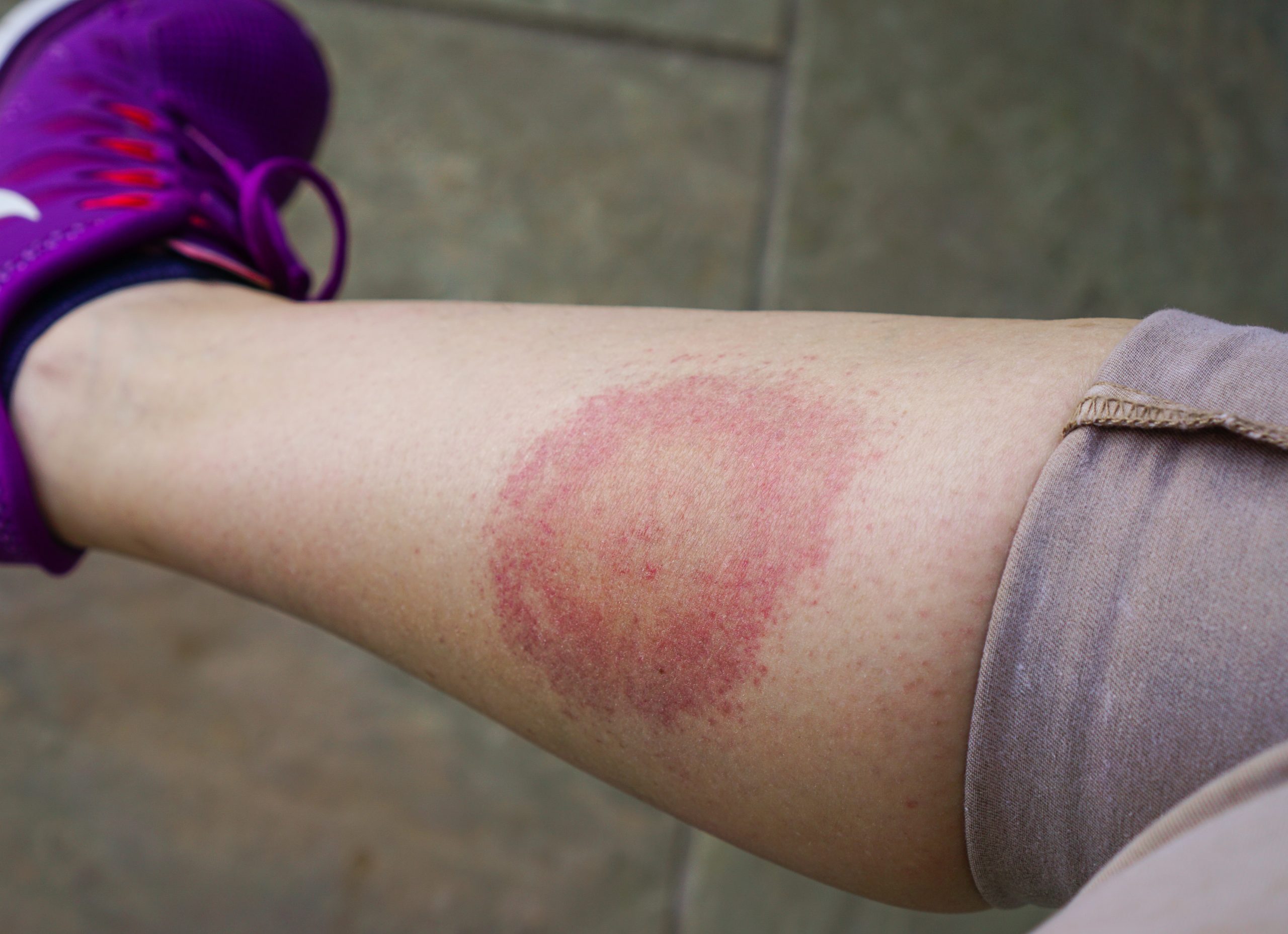 bulls-eye-rash-scaled.jpg bulls-eye-rash-scaled.jpg