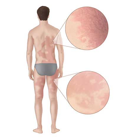 alpha-gal-allergy-illustration.jpg