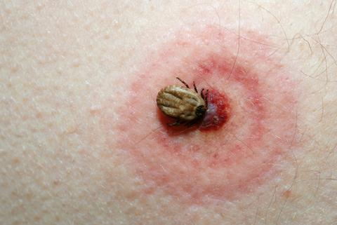 tick-bite.jpg