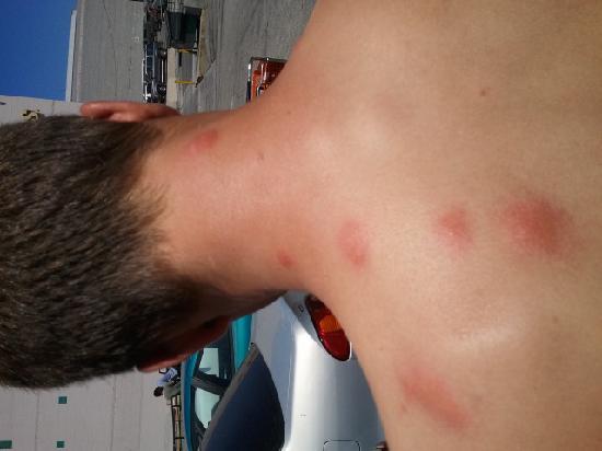 bites-on-my-back.jpg