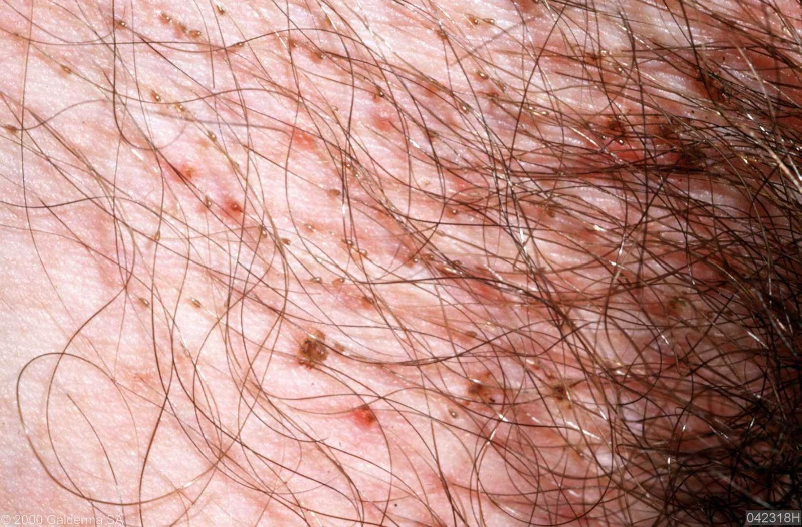 pediculosis-2.jpg pediculosis-2.jpg