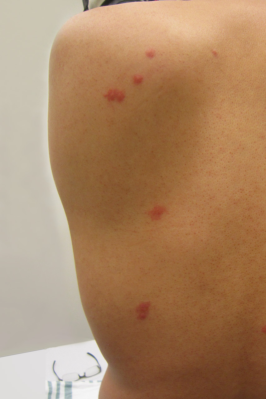 treating-bed-bug-bites.jpg