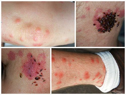 bed-bug-bites-4.jpg