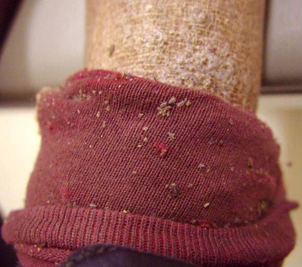 pediculosis-corporis-1-high-621-550-70.jpg